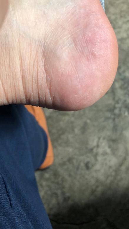 1625041903.jpg 痛風又發作了怎么辦3.jpg